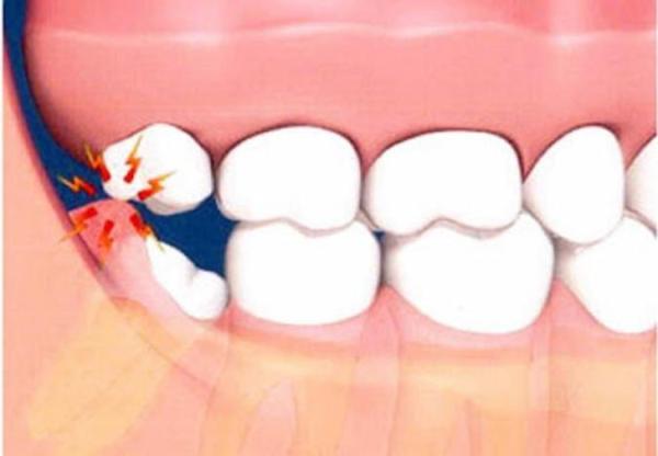 کشیدن دندان عقل مفید یا مضر