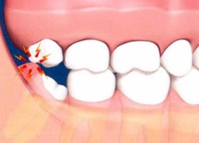کشیدن دندان عقل مفید یا مضر