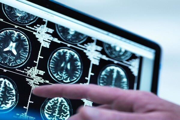 هوش مصنوعی چگونه می تواند به تشخیص علائم اولیه آلزایمر یاری کند